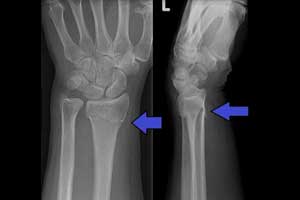 FDA Approved: AI Algorithm That Helps Detect Wrist Fractures