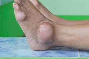 One fourth of gout patients have sleep disorders