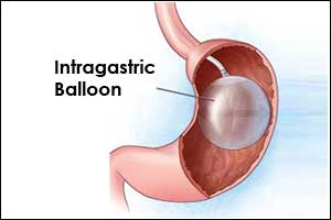 Case of Gastric outlet obstruction after intragastric balloon treatment for obesity