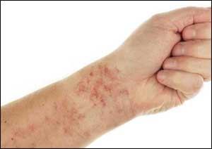 Guideline based Management of Chronic Urticaria