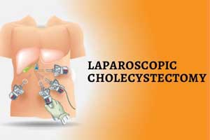 Dexmedetomidine Infusion effectively controls pain during Laparoscopic Cholecystectomy
