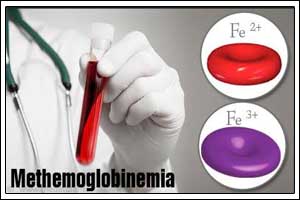 Local Benzocaine may lead to Methemoglobinemia in children
