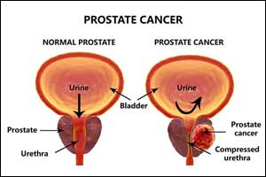 Enlarged prostrate impedes growth of prostrate cancer,suggests new research
