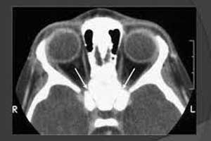 A 6-yr-old with Osteopetrosis