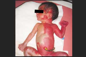 A Half-Red Baby: NEJM case report