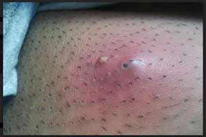 Contezolid may be new antibiotic for Acute Bacterial Skin Infections