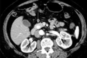 CT Combined with angiography effective for diagnosing insulinomas