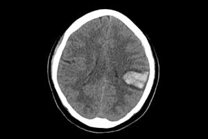 CT black hole sign accurately predicts hematoma expansion in ICH