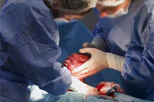 Cesarean delivery associated with increased pregnancy complications for mothers