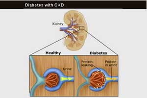 Dulaglutide as effective as insulin glargine in diabetes with CKD : Lancet