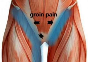 New surgery for groin pain found to be more effective than physiotherapy