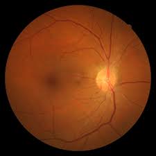 Aflibercept- future drug for Non-Proliferative Diabetic Retinopathy