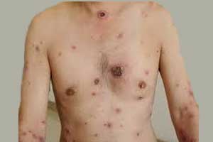 A case of Malignant syphilis in a young man with HIV infection