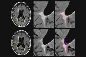 Atrophied brain lesions in MRI indicate progression of Multiple Sclerosis : Study