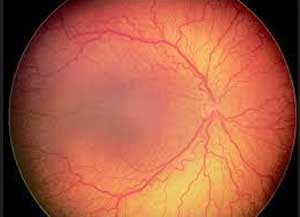 Low-dose Bevacizumab effective in Retinopathy of Prematurity