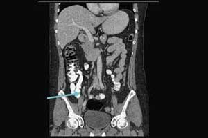 Bilateral Renal Infarctions During the Use of Painkiller (Sumatriptan)