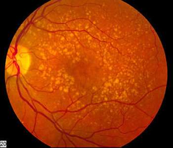 Prolonged use of Anticholinergic drugs linked to Macular degeneration