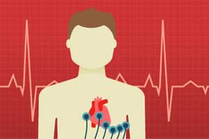 Updated guidelines for cardiac screening in young patients