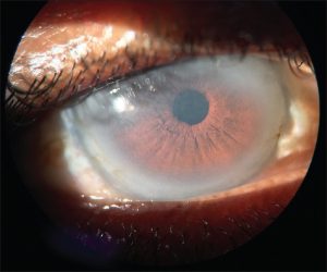 Secret in the eyes - fish eye disease