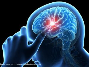 Simple test may predict prognosis of  stroke