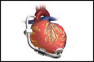 New cardiac pump device more cost effective than Standard Pump