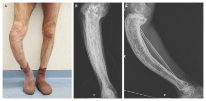 Case Report of Saber Tibia in Pagets Disease of Bone