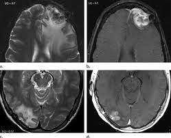 MR spectroscopy facilitates, targets, tracks treatment in gliomas