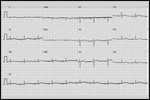 A case presenting with recurrent syncope during sexual activity