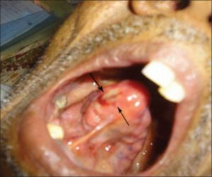 A unique case of Squamous cell carcinoma on a syphilitic gumma