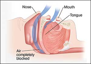 Sleep apnea patients at higher risk for heart problems after surgery: JAMA