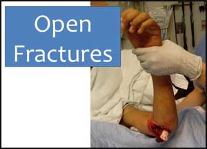 Standard dressing as good as Hi Tech wound therapy in open leg fractures