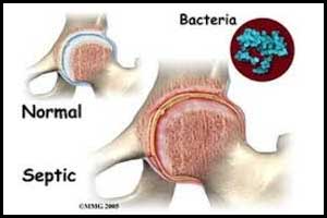 New compound for treating Prosthetic Joint Infections discovered