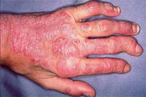 ACR and NPF release Joint guideline for psoriatic arthritis