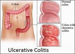 Patient with ulcerative colitis who developed Sweet syndrome: JAPI Case Report