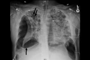 A rare case of septic pulmonary emboli presenting as bilateral pneumothorax