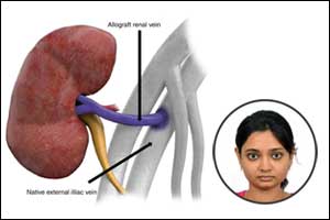CT Volumetry as good as  Scintigraphy to predict outcome in Renal Donors : Dr. Niharika Prasad