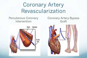 Long term Stroke rate lower after PCI  vs  CABG in CAD : JACC