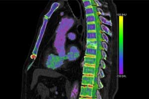 Detection of bone marrow edema possible through DECT: European Radiology