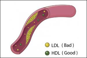 Good cholesterol does not decrease heart disease risk in postmenopausal women