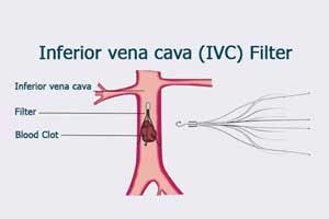 Inferior vena cava filters linked to increased mortality in VTE patients: JAMA