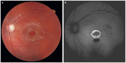 A case of Macular Hole caused by  a Laser Pointer
