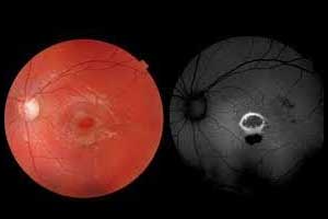 Intravitreal steroids most effective treatment for Uveitic Macular Edema