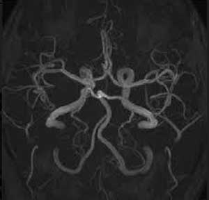 A rare case of Diabetes presenting with Quadriparesis