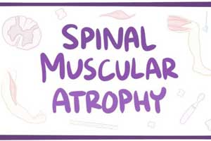 Nusinersen improves motor function in kids with Spinal muscular atrophy