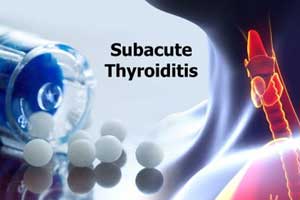 A case of Subacute Thyroiditis following attack of Dengue Fever