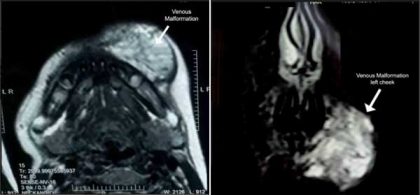 A Case of Vascular Malformation treated by Sclerotherapy