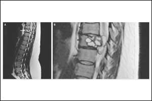 Patient felt electric shocks in legs -turned out a case of Vertebral Hydatidosis