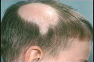 Baldness can now be treated with platelet-rich plasma