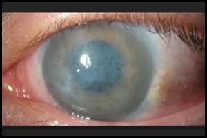 New treatment restores corneal clarity in patients with bullous keratopathy