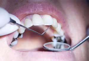 Antibiotic Use for management of dental Pain and Intra-oral Swelling: ADA Guidelines